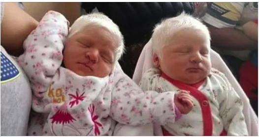 The First Ever Albino Twins Born In Argentina Will Leave You In Awe